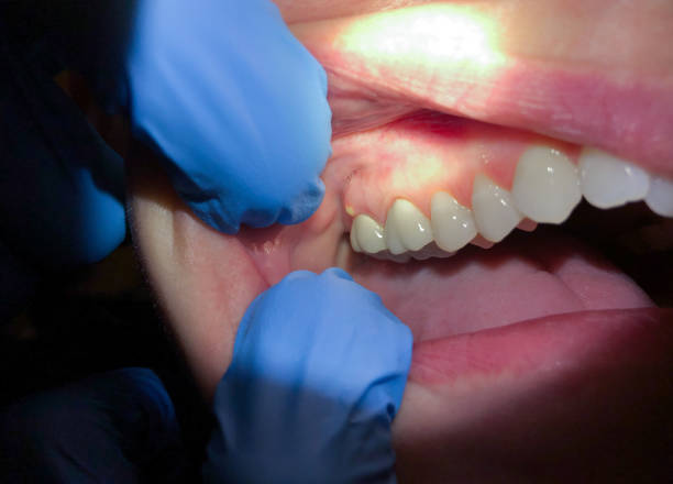 Best Dental Abscess Treatment in USA